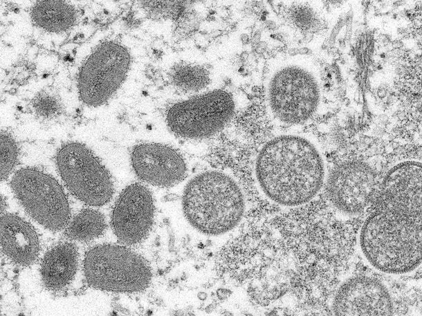 FIRST CASE OF ‘MONKEYPOX VIRUS’ DETECTED IN U.S. THIS YEAR ‘THE NEW PANDEMIC’